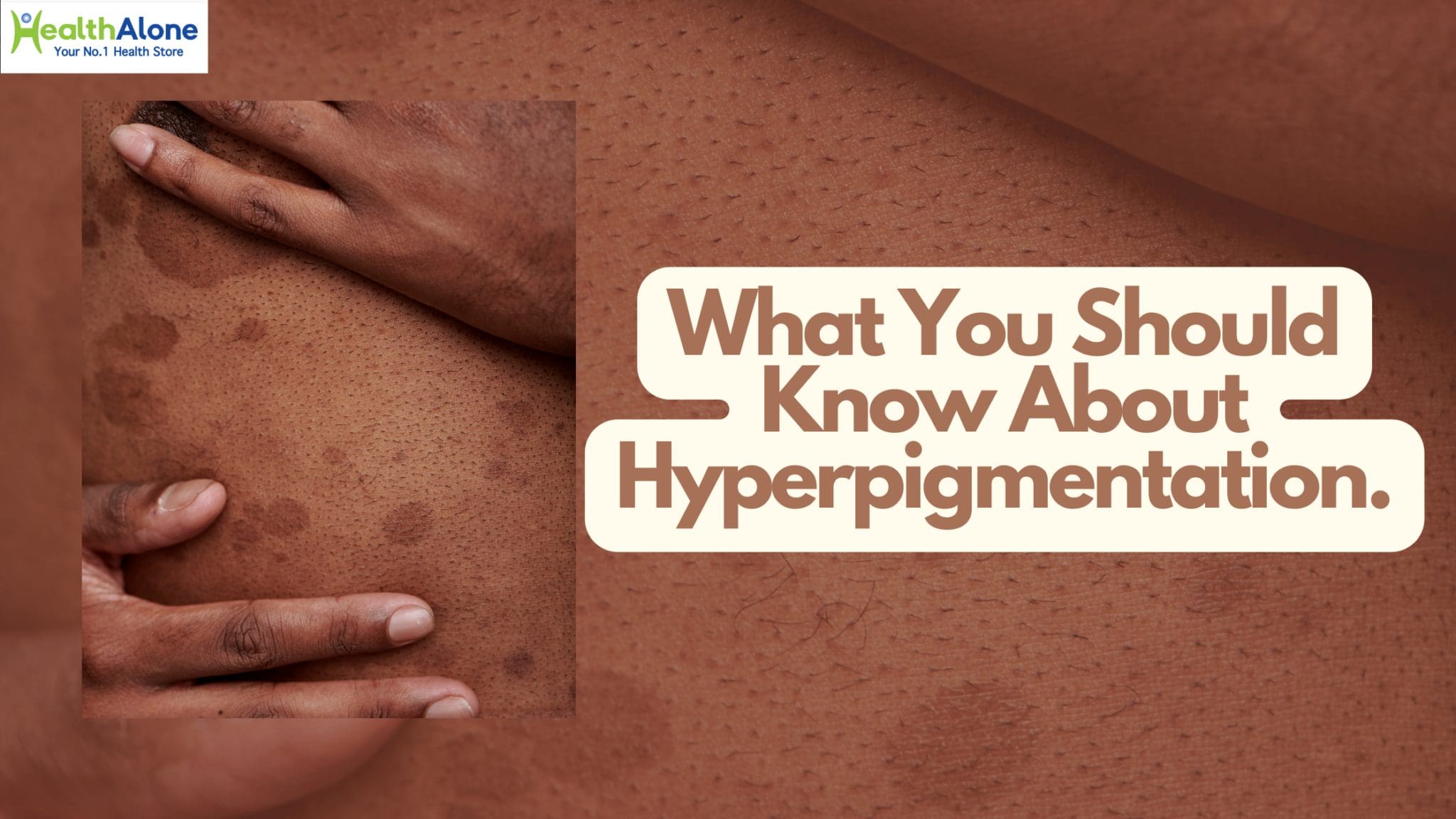 Health Alone Your No. 1 Health Store What You Should Know About Hyperpigmentation,