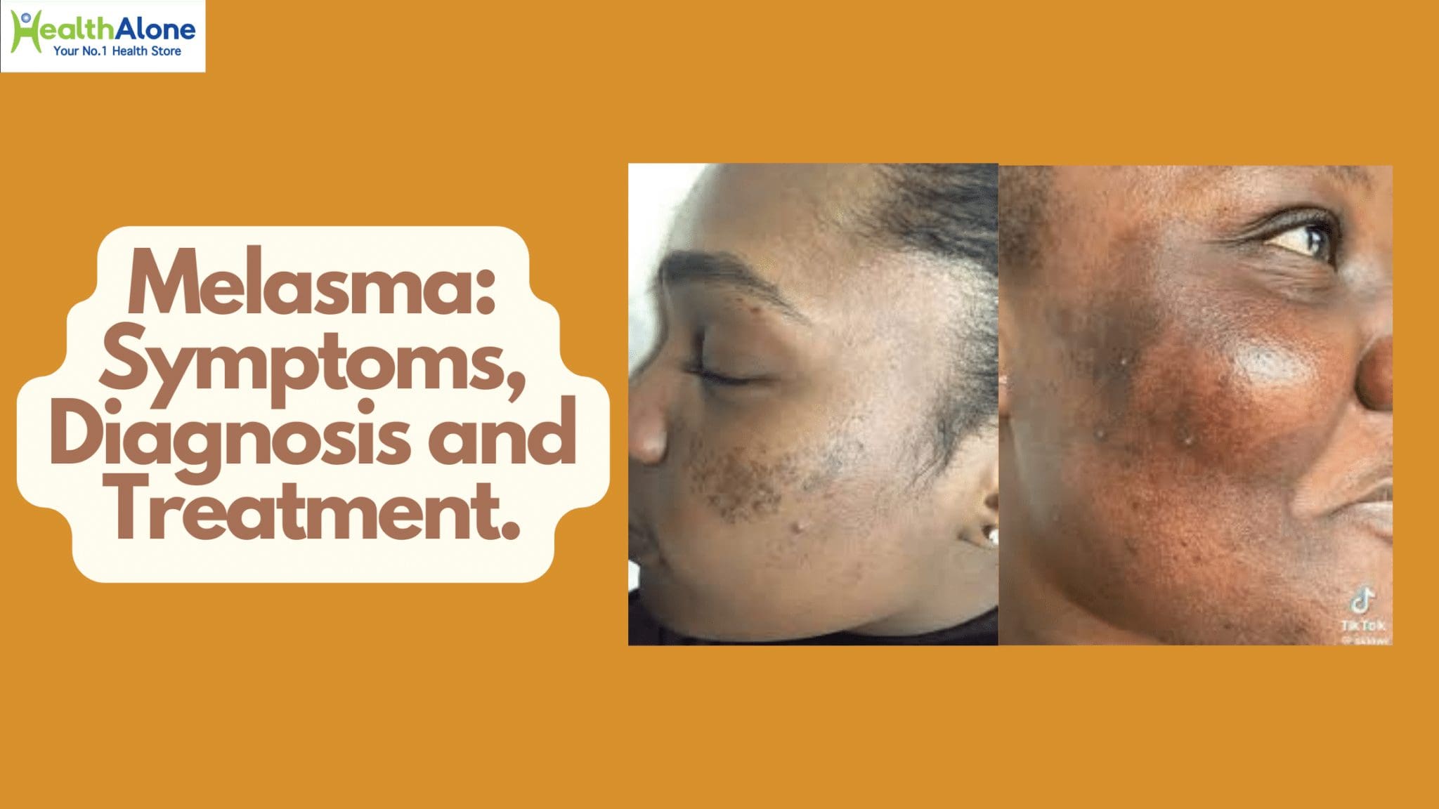 Health Alone Your No. 1 Health Store Melasma: Symptoms, Diagnosis and Treatment,